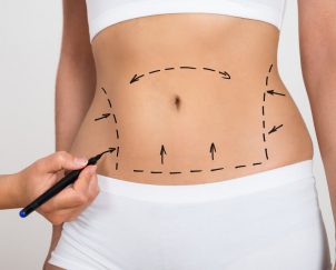Aplicação de Botox Barriga